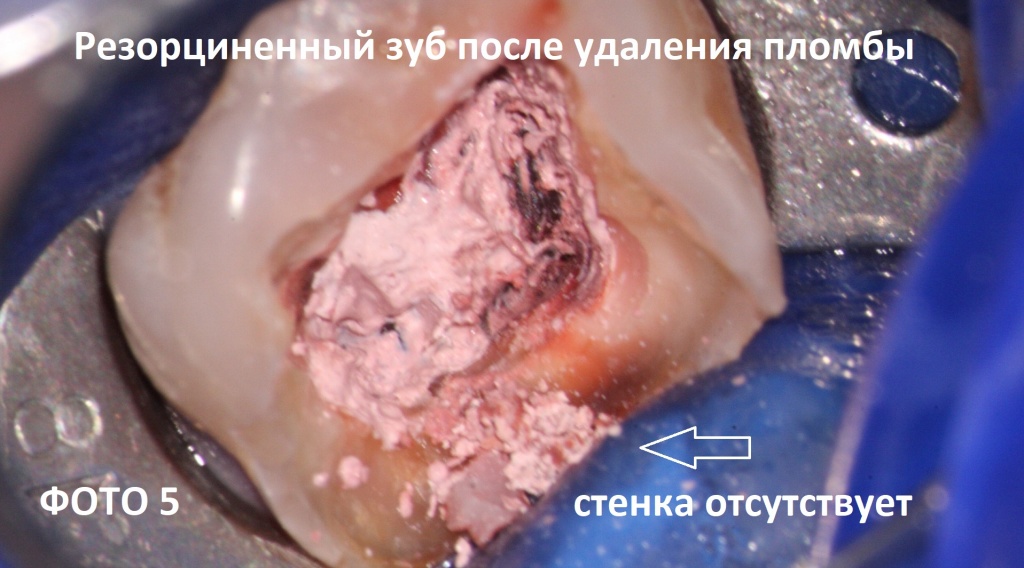 Вид полости зуба после удаления старой пломбы